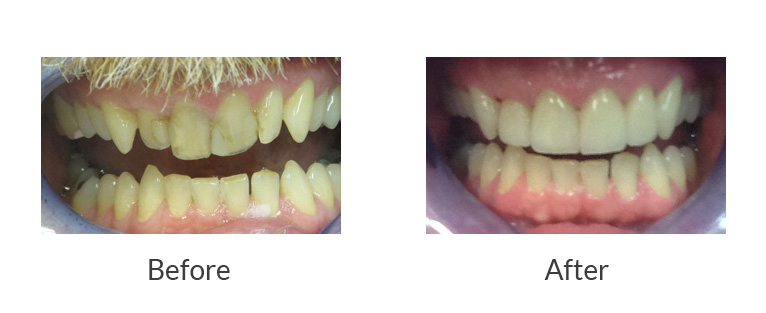 Bay Street Family Dental Restorative Crowns Manchester NH