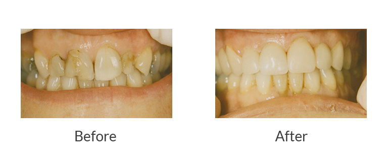 Bay Street Family Dental Filling Replacement Manchester NH