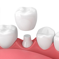 Dental Crowns Manchester NH