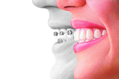 Invisalign Dentist Manchester NH