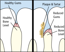Dental Gum Disease Manchester NH